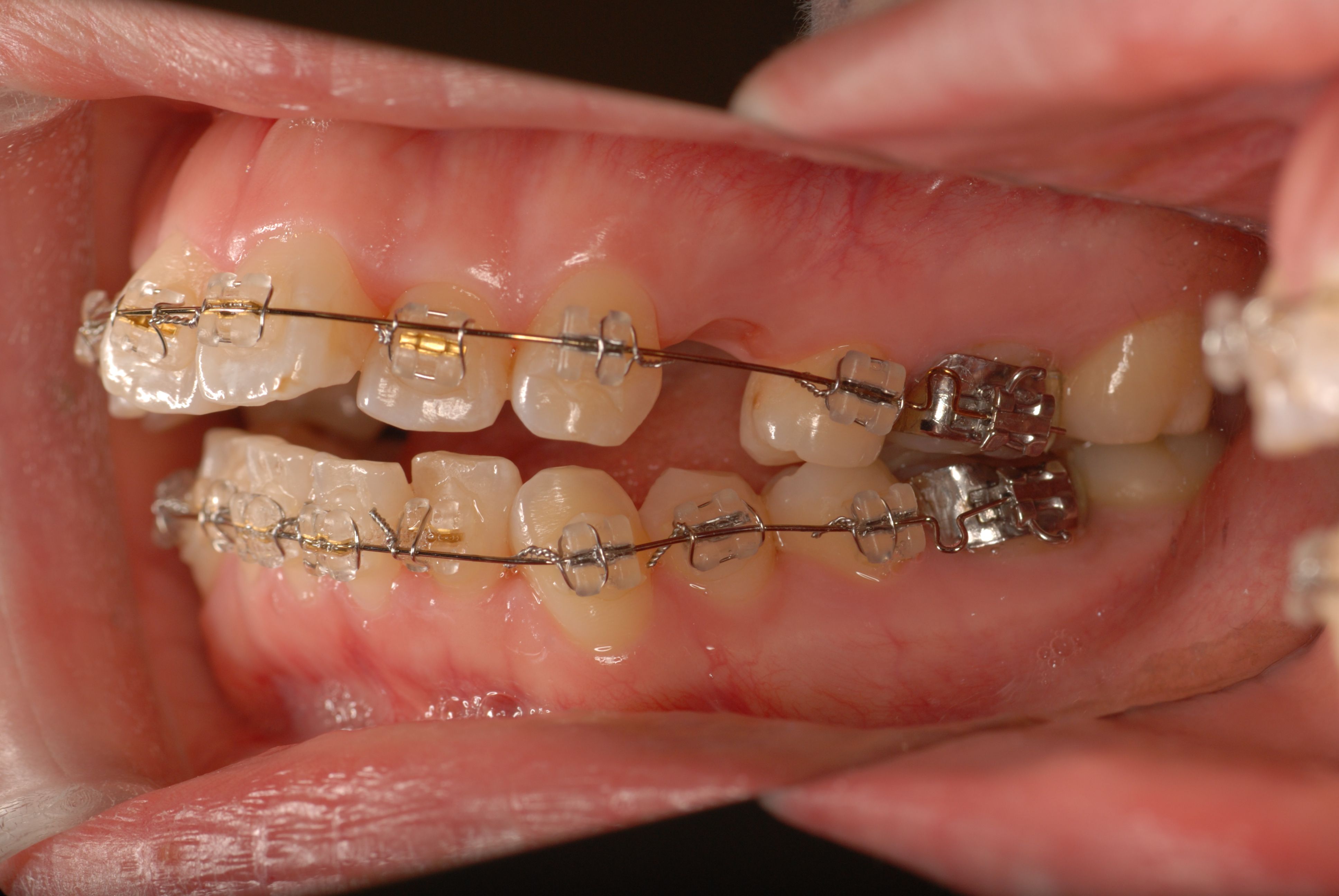 矯正の症例 かるがも先生のブログ 上越市 矯正歯科 かるがも矯正歯科