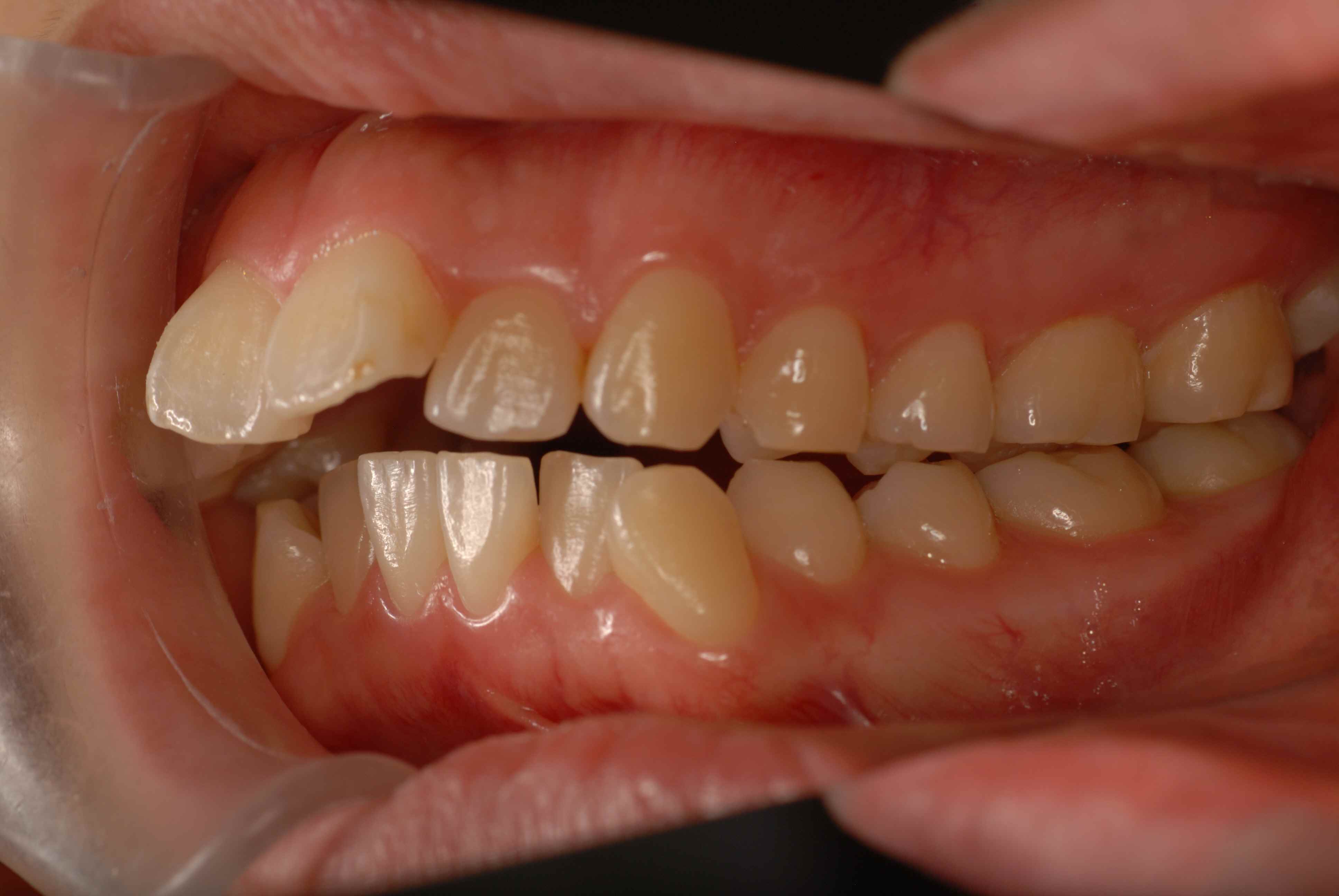 矯正の症例 かるがも先生のブログ 上越市 矯正歯科 かるがも矯正歯科