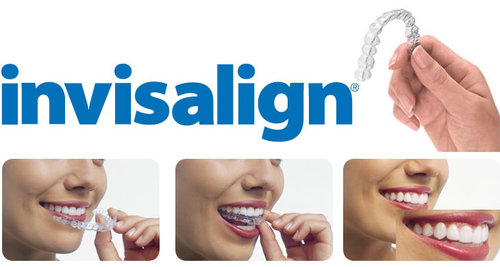 variation-invisalign000.jpg